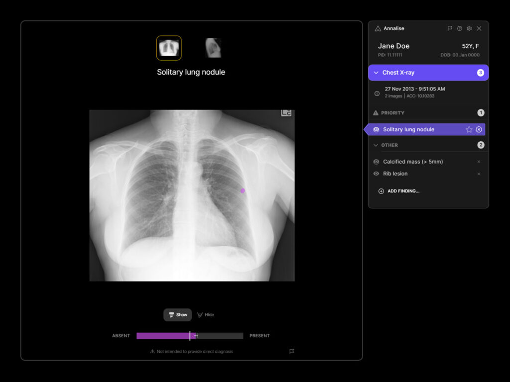 Photo shows Annalise AI Chest X-ray solution detecting potential lung cancer findings